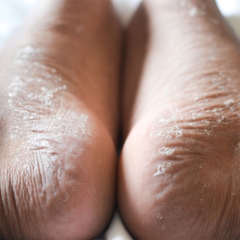 Athletes Foot