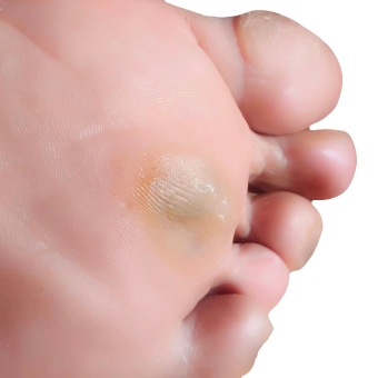 Calluses and Dry Skin