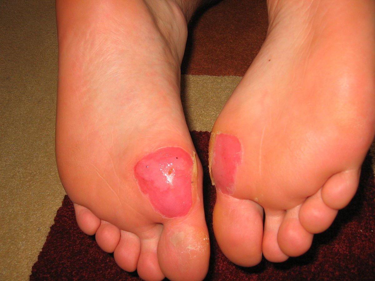 Large blister shop on heel