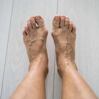 Hallux Valgus