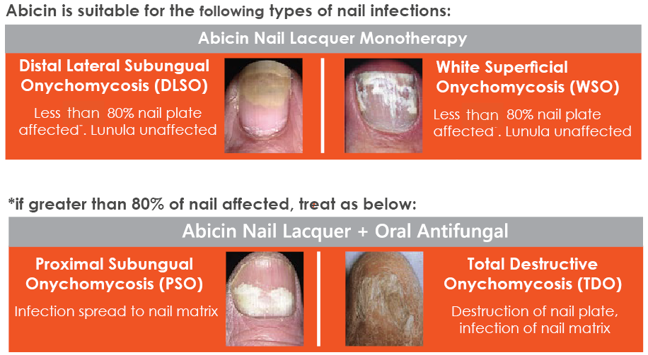 Fungal Nails